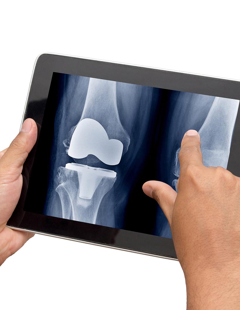 Global Knee Replacement Market 2024-2028