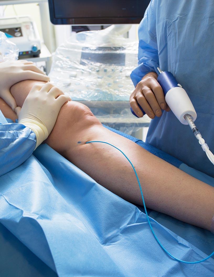 Global Peripheral Guidewires Market 2025-2029