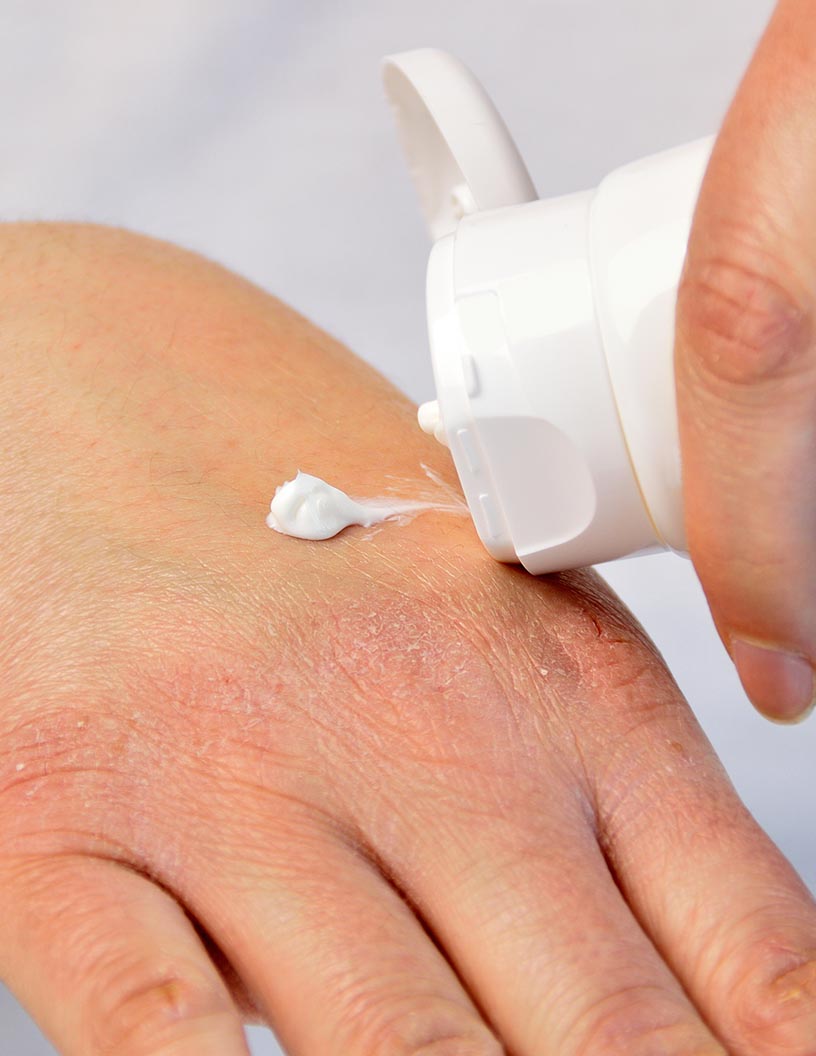 Global Eczema Therapeutics Market 2024-2028