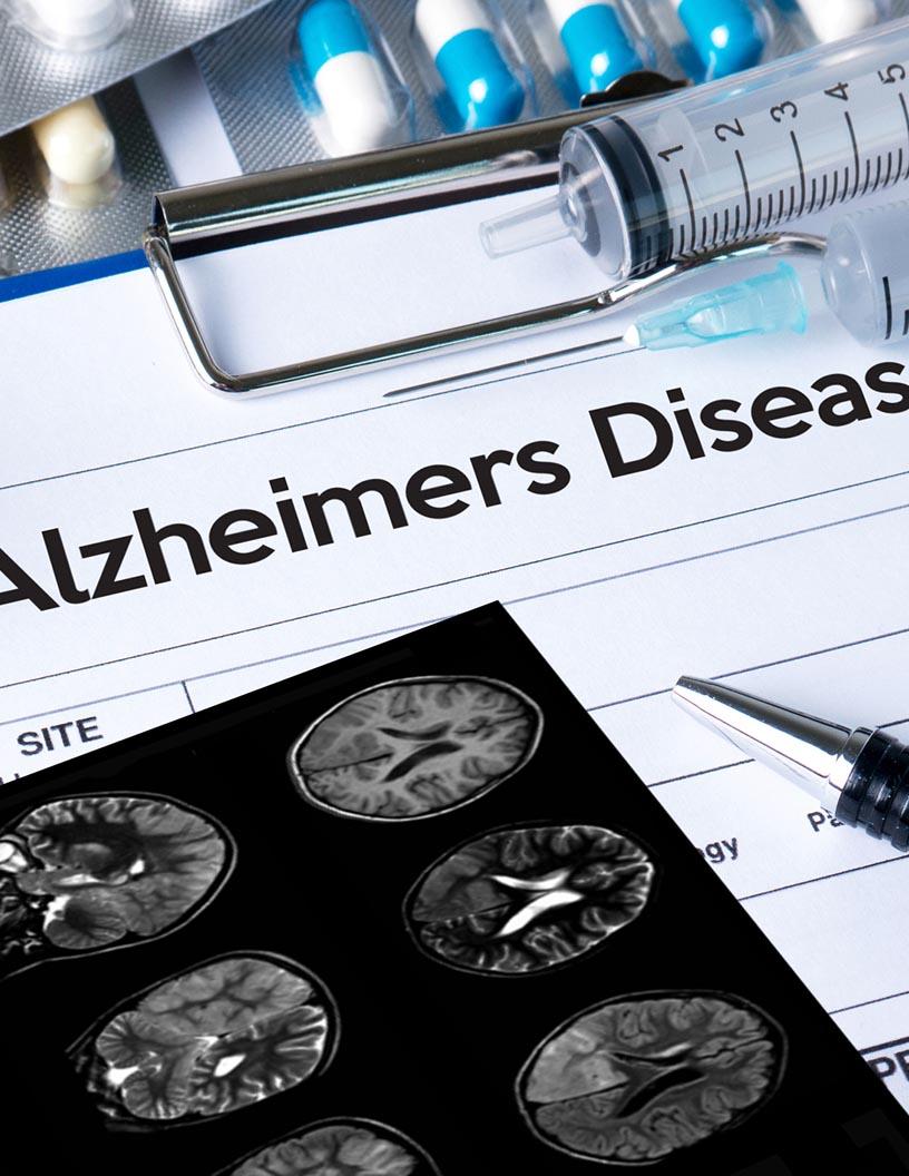 Global Alzheimers Disease Therapeutics Market 2025-2029