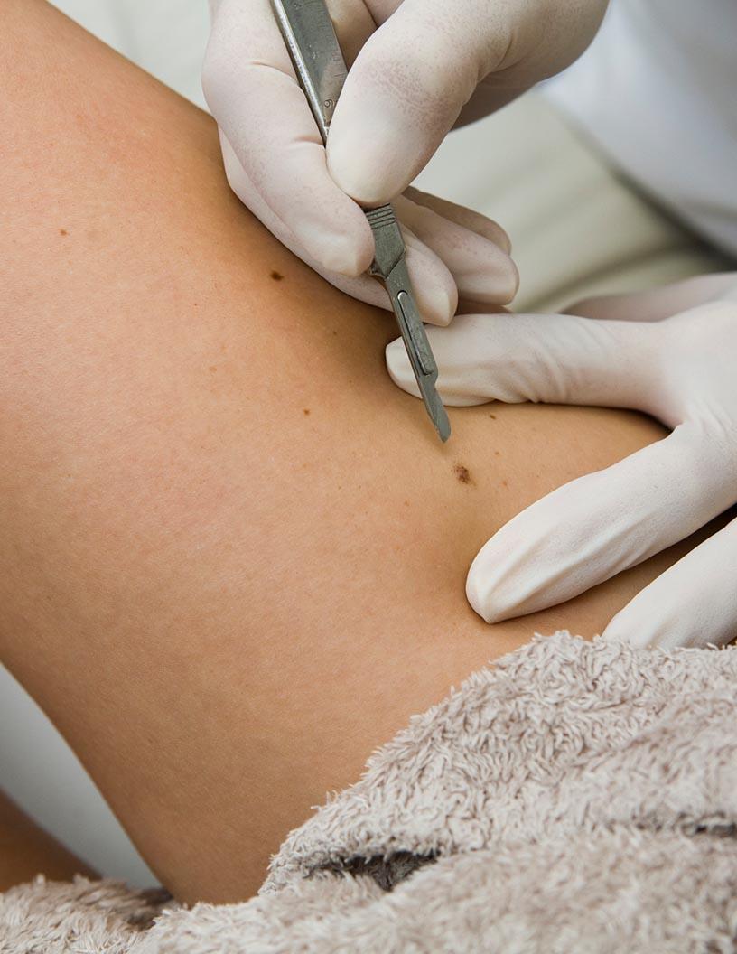 Global Non-Cancerous Skin Diseases Therapeutics Market 2025-2029