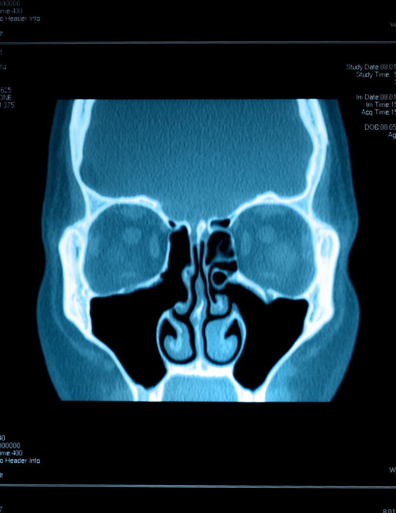 Global sinus dilation devices market 2024-2028