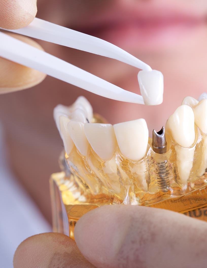 Global Dental Implants Market 2025-2029