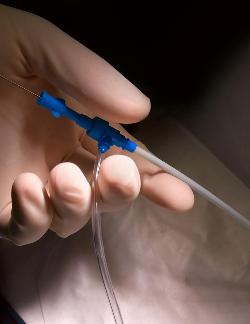 Global cardiovascular catheters market 2024-2028