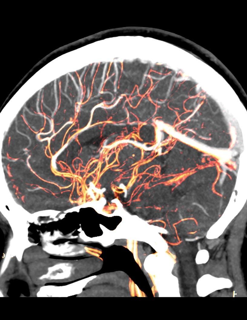 Global Flow Diversion Aneurysm Treatment Market 2025-2029