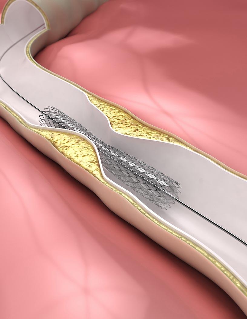 Global Embolic Protection Devices Market 2025-2029