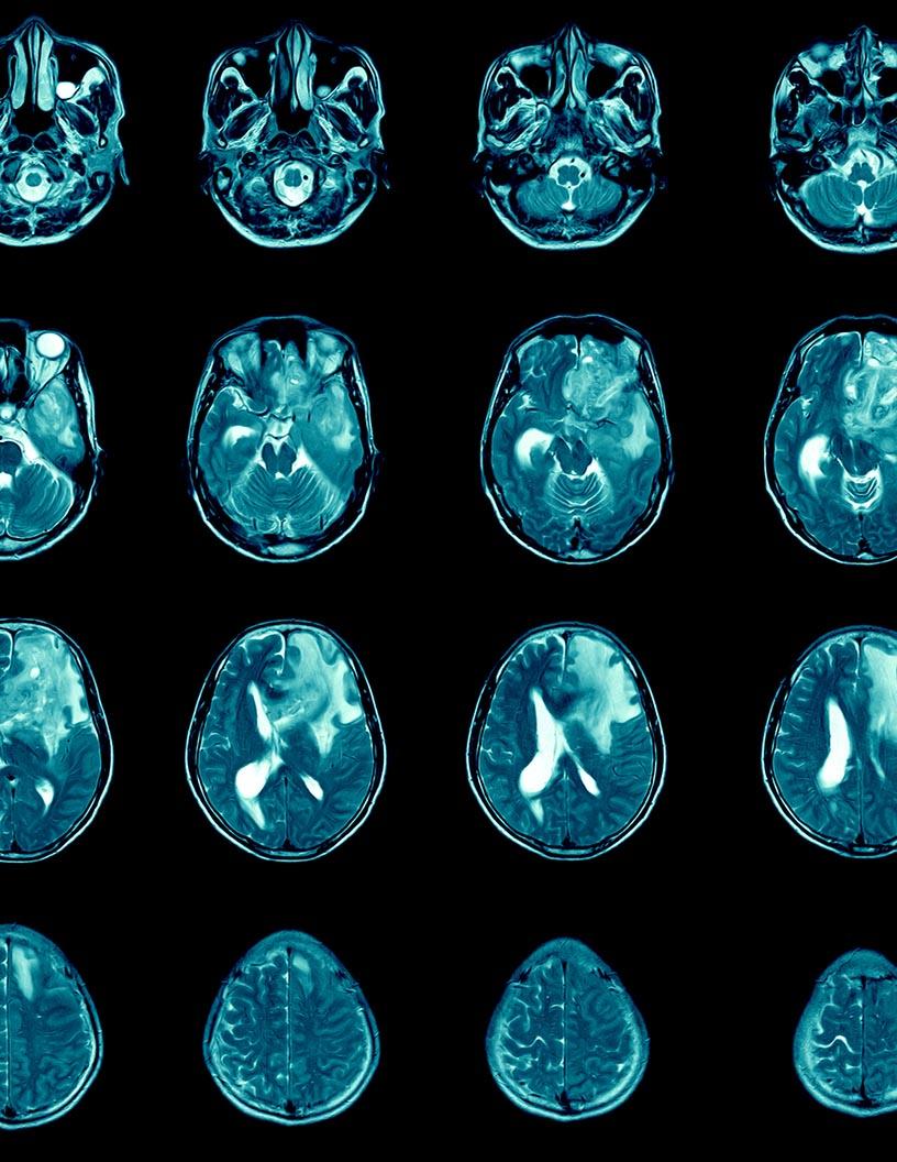 Global Glioblastoma Multiforme Treatment Market 2024-2028