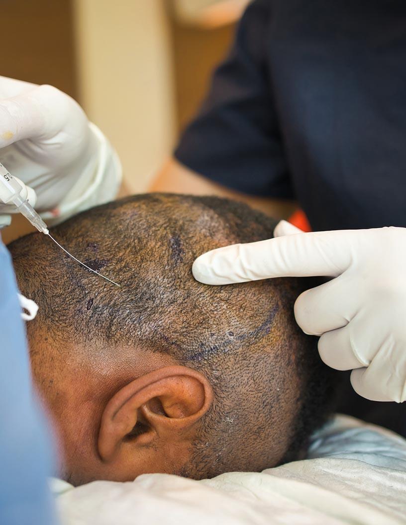 Global Hair Transplant Market 2024-2028