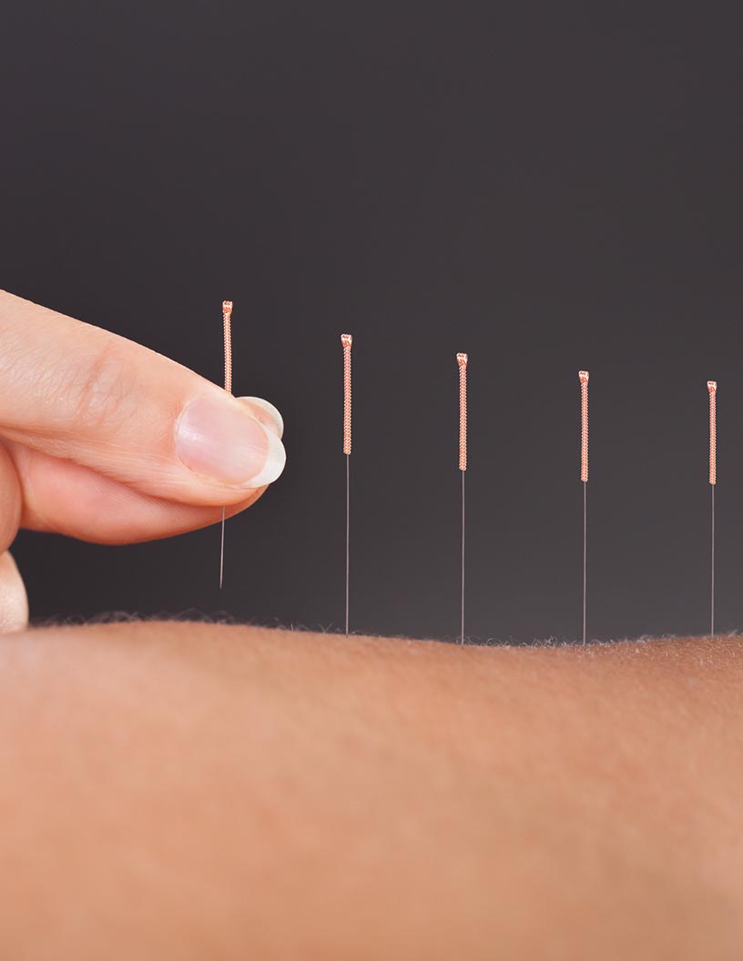 Global acupuncture market 2024-2028