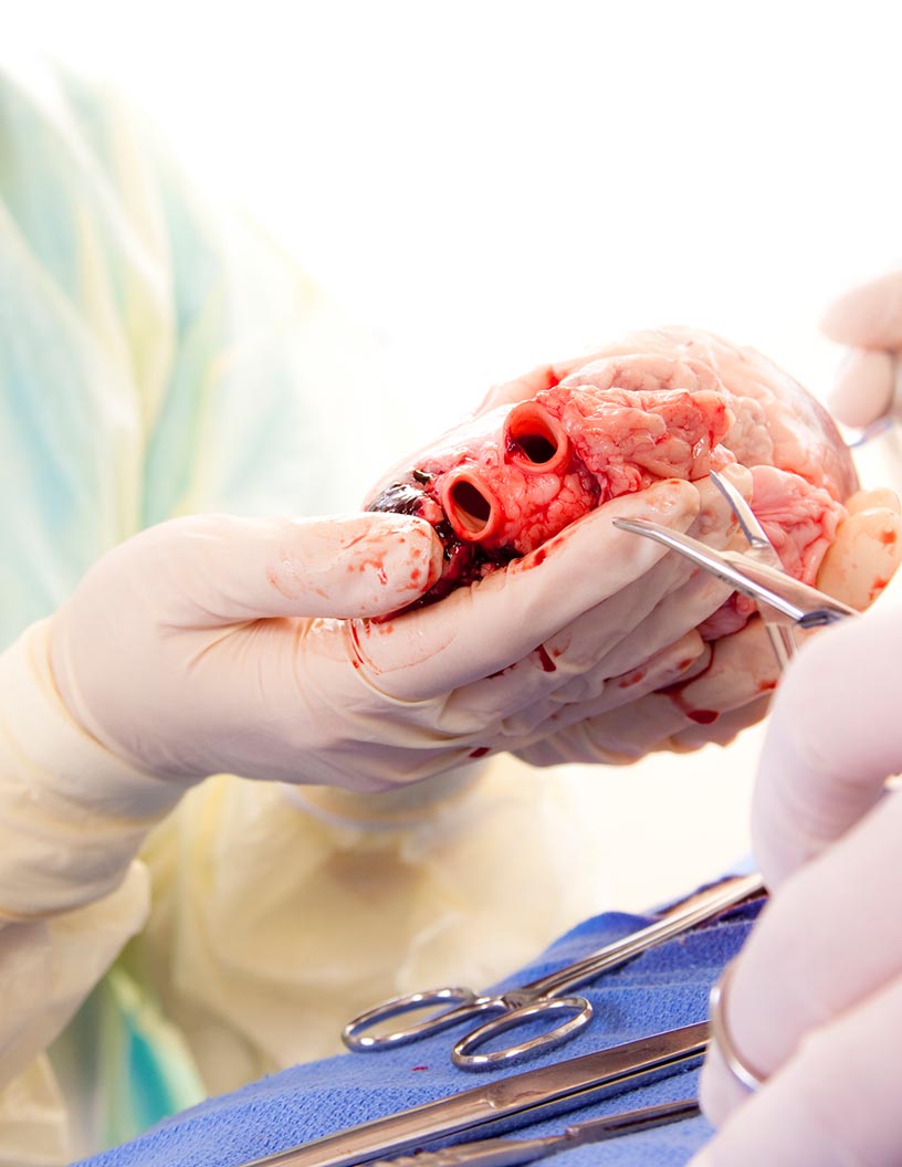 Global vascular grafts market 2024-2028
