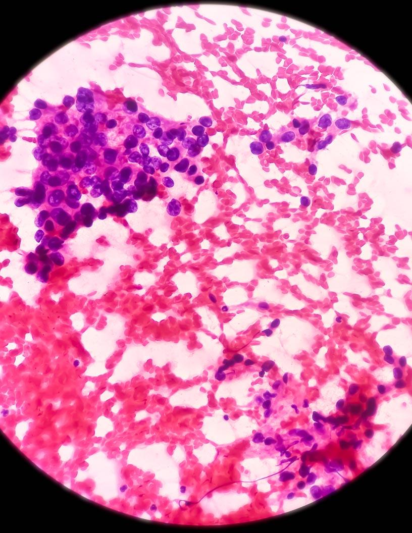 Global Liver Cancer Drugs Market 2025-2029