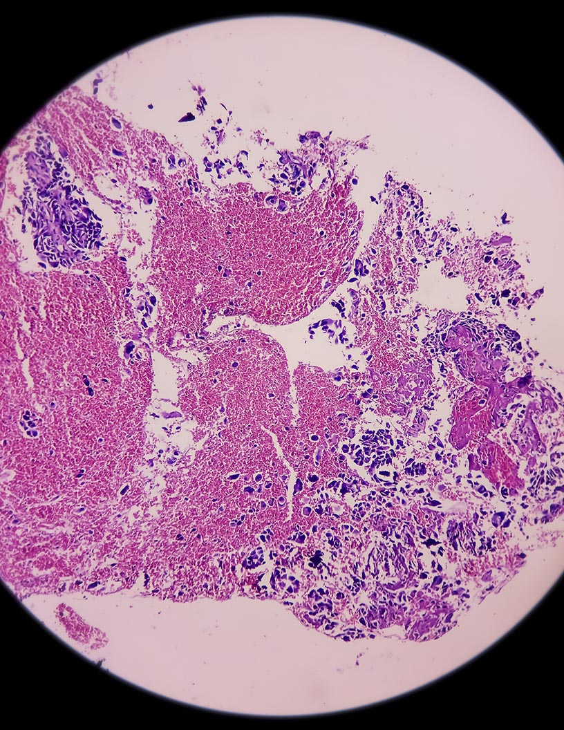 Global sarcoma therapeutics market 2024-2028