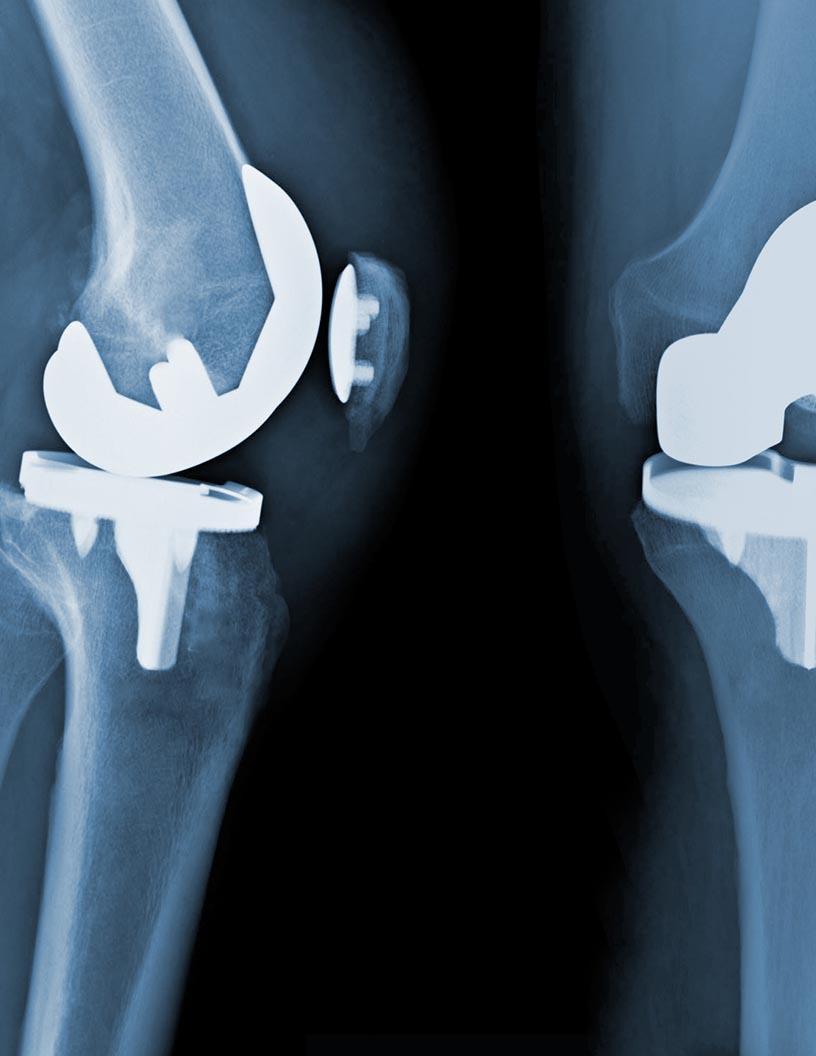 Global digit joint implants market 2024-2028