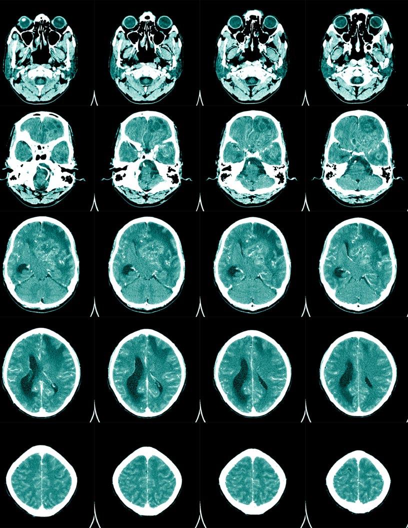 Global Non-Invasive Intracranial Pressure Monitoring Devices Market 2025-2029