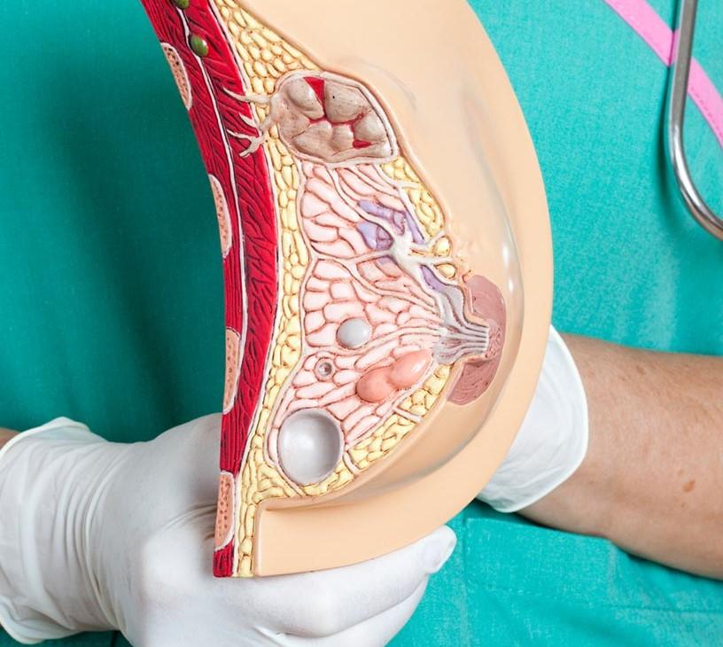 Global Breast Tissue Expander Market 2025-2029