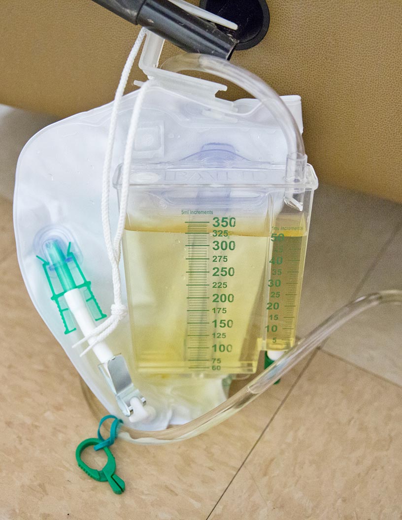Global Disposable Urinary Drainage Bag Market 2024-2028