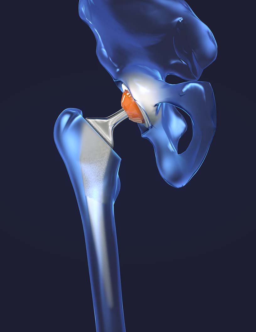 Global bone replacement market 2024-2028