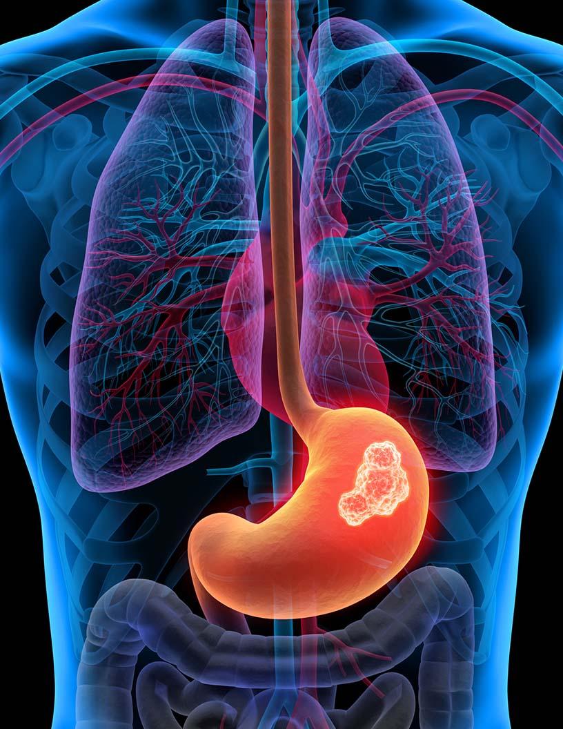 Global Gastric Cancer Drugs Market 2025-2029