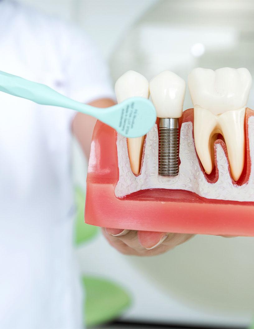 Dental Implants Market in China 2025-2029
