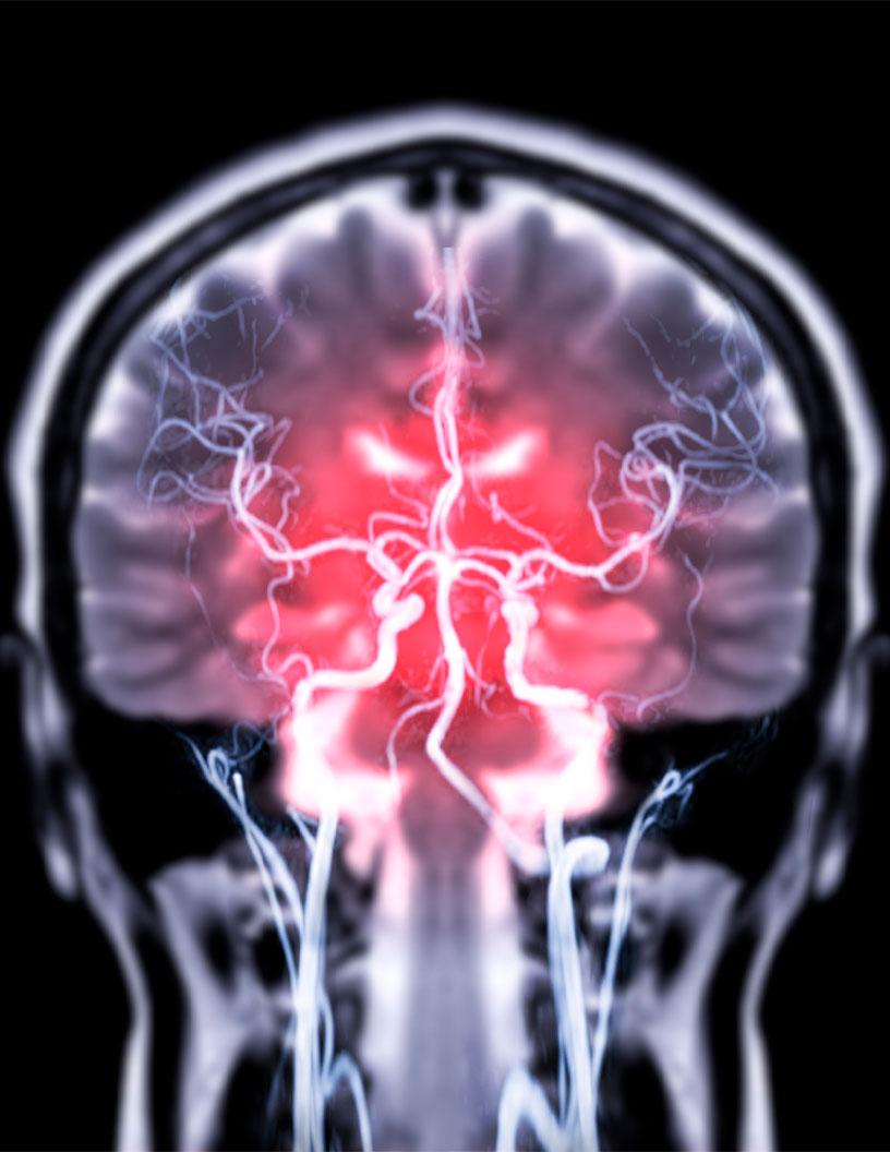 Global Neuroendovascular Non-Coils Market 2025-2029