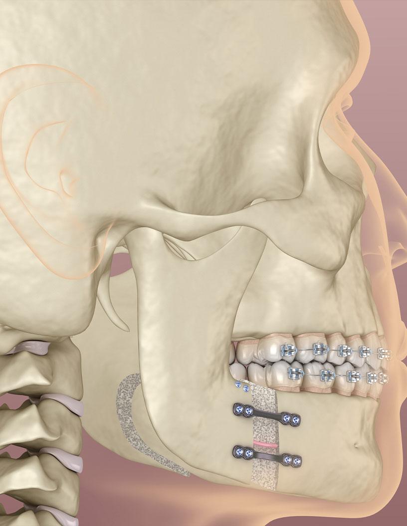 Global Distraction Osteogenesis Devices Market 2025-2029