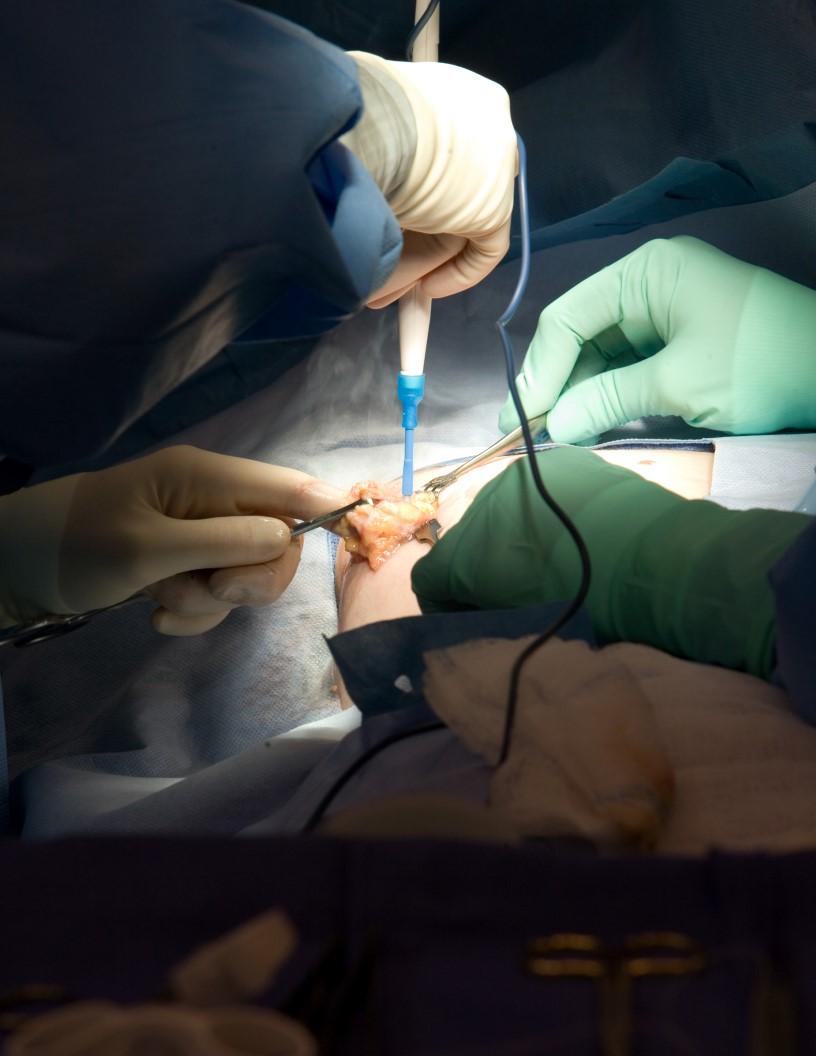 Global Mastopexy Market 2025-2029