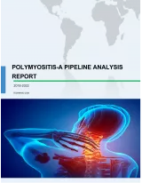 Polymyositis - A Pipeline Analysis Report